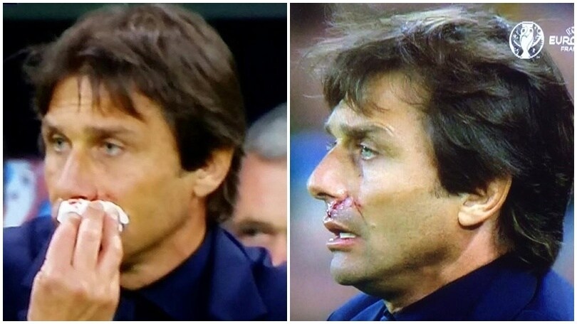 Euro 2016, Belgio-Italia: Conte esulta e si fa male: sangue al naso per il ct!