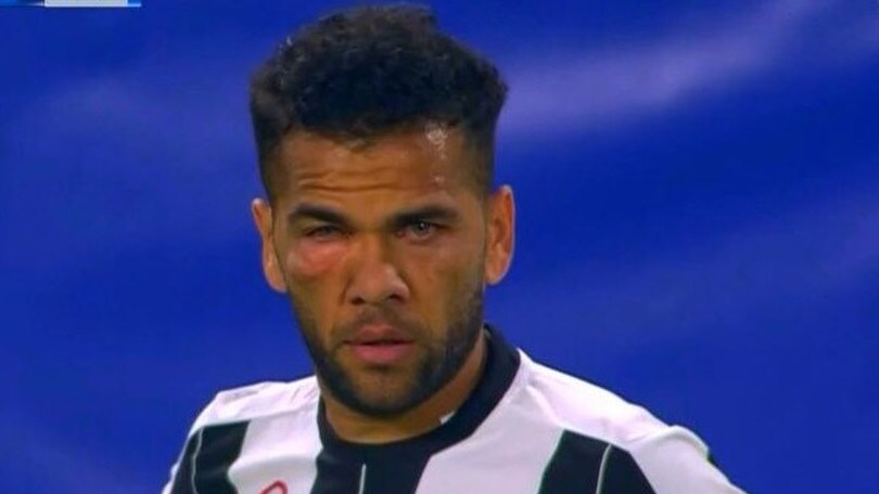 Juventus-Lione, Dani Alves come Rocky: che botta all'occhio!