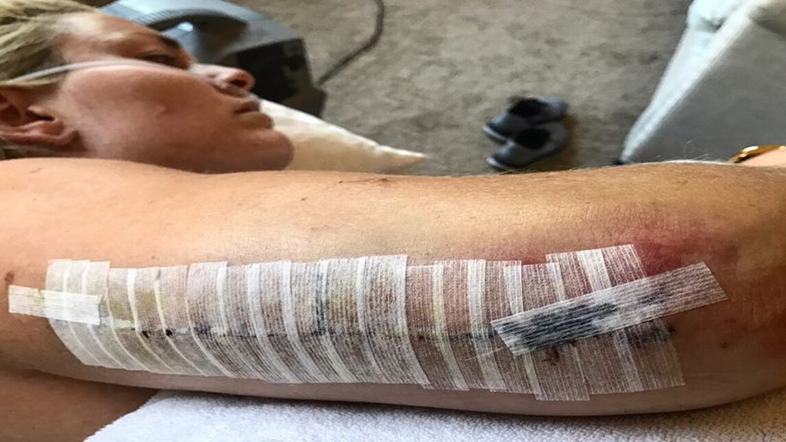 Lindsay Vonn, ecco la foto post-operatoria