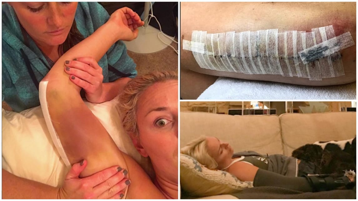 Lindsey Vonn: le foto choc dopo l'intervento al braccio
