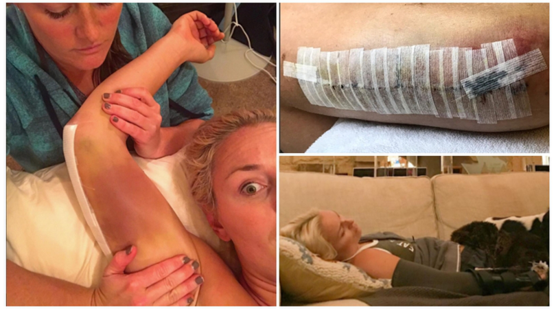 Lindsey Vonn: le foto choc dopo l'intervento al braccio
