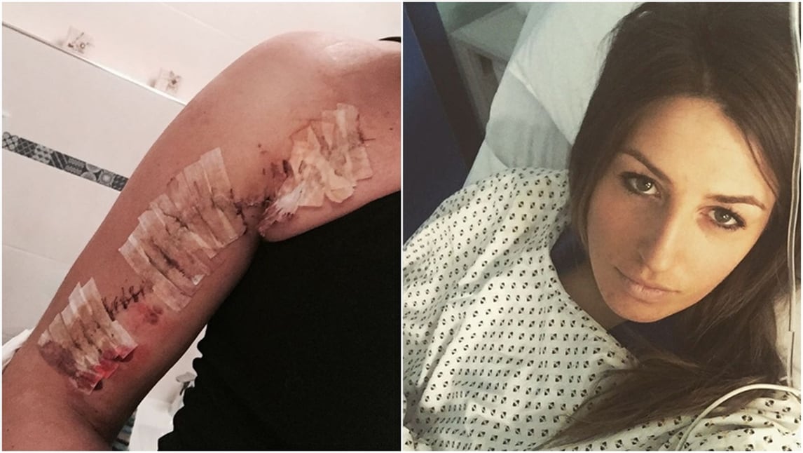 Nadia Fanchini shock su Instagram: ecco la cicatrice dopo l'operazione