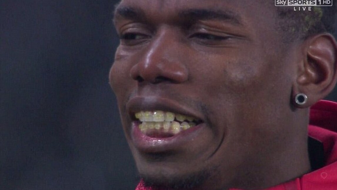 Pogba, sorriso perfetto? Ecco l'apparecchio