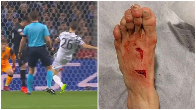 Porto-Juventus, il fallo di Lichtsteiner costa a Herrera 17 punti di sutura