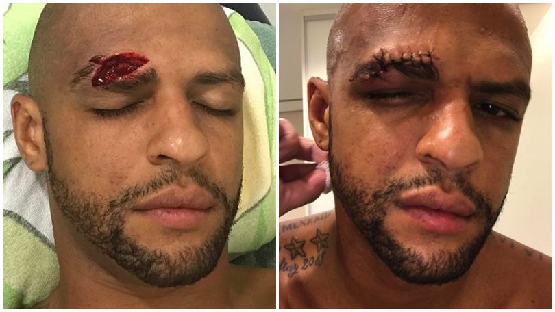 Felipe Melo, infortunio shock, 13 punti di sutura al sopracciglio