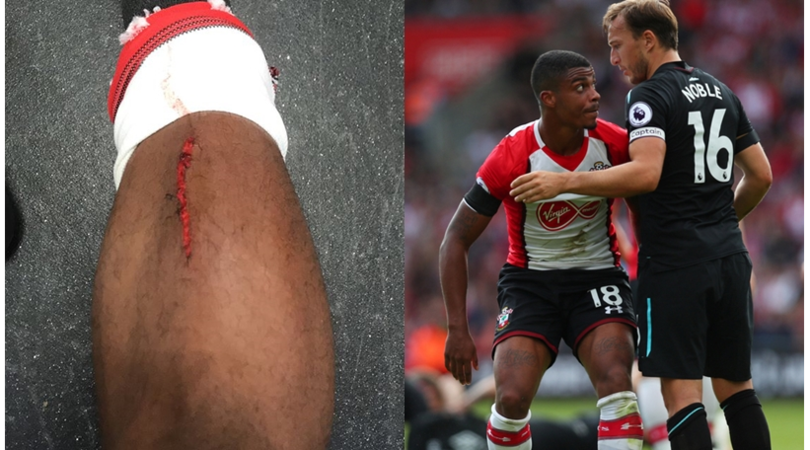 Southampton: Lemina mostra la ferita causata dall'intervento di Noble