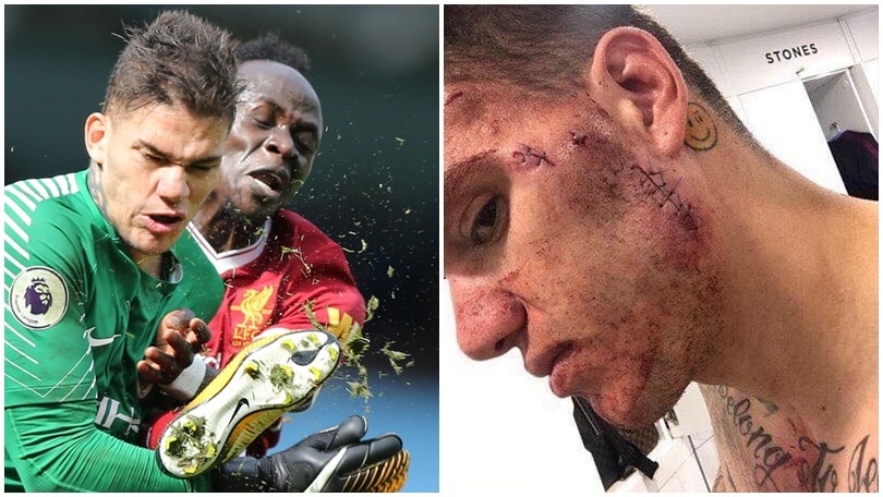 Manchester City, guardate come è ridotto Ederson dopo il colpo di Mané