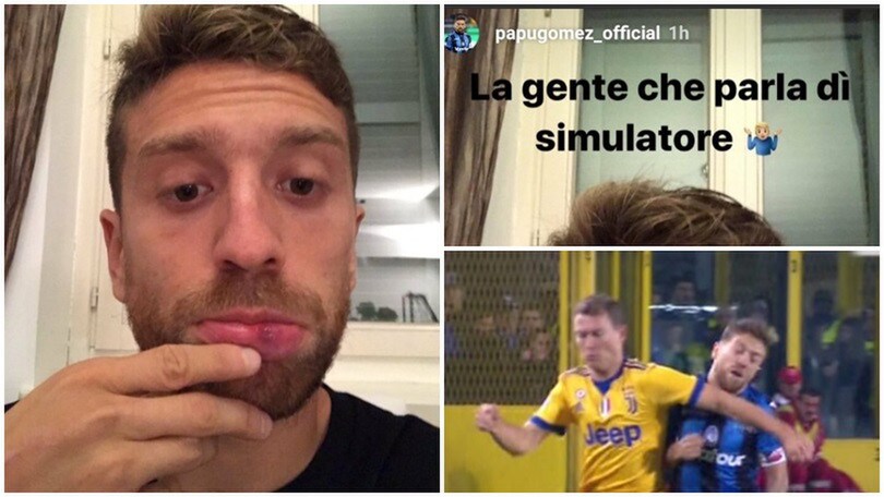 Atalanta-Juventus, Gomez mostra il labbro gonfio: «Per chi parla di simulatore»