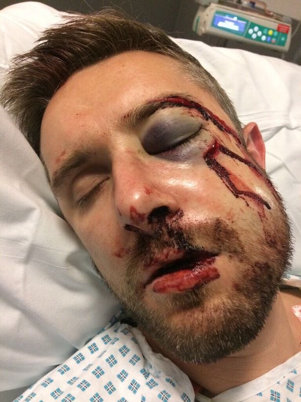 Infortunio shock per il difensore del Port Vale: rischia danni permanenti