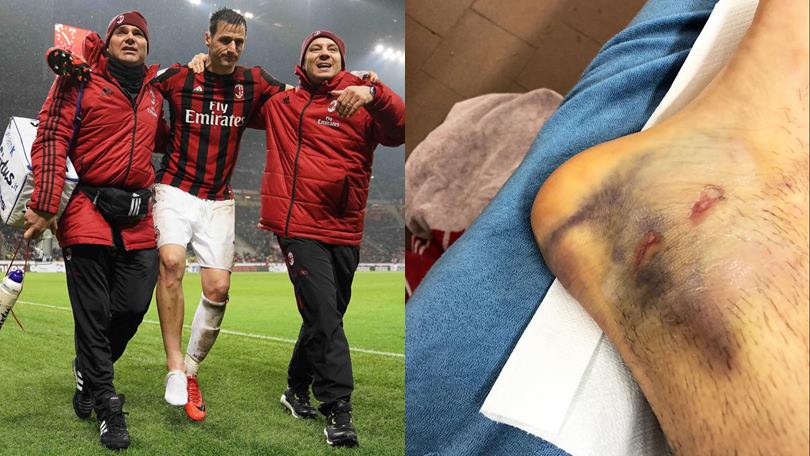 Milan, Kalinic ko: ecco com'è ridotta la sua caviglia