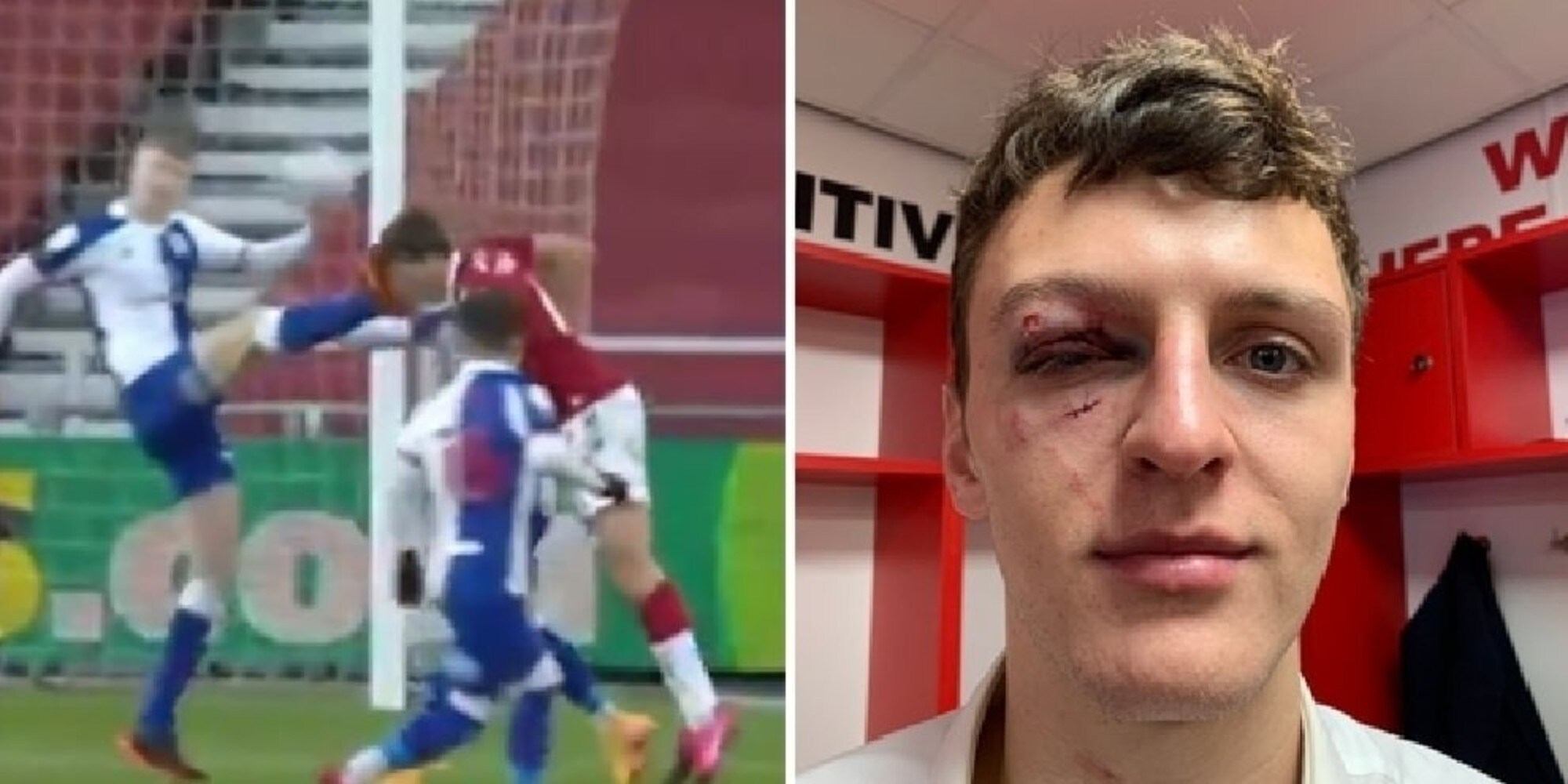 Dael Fry, infortunio shock: "Un millimetro più in là e avrebbe perso l'occhio"