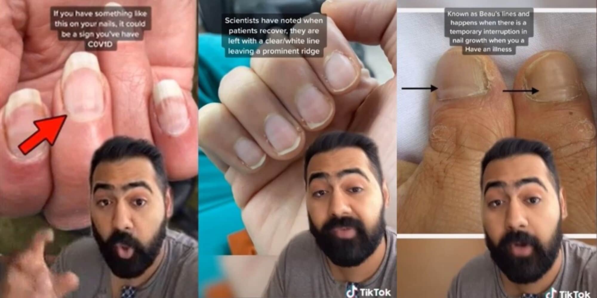Il medico che insegna su TikTok a scovare il Covid dalle unghie