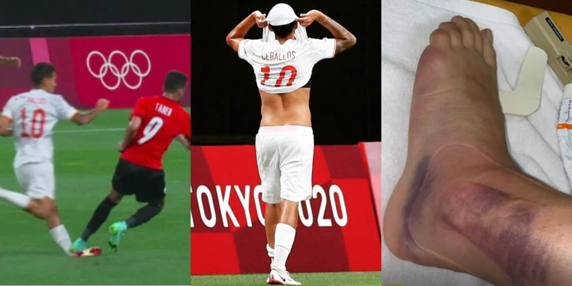 Dani Ceballos, caviglia ko in Egitto-Spagna: la foto è impressionante