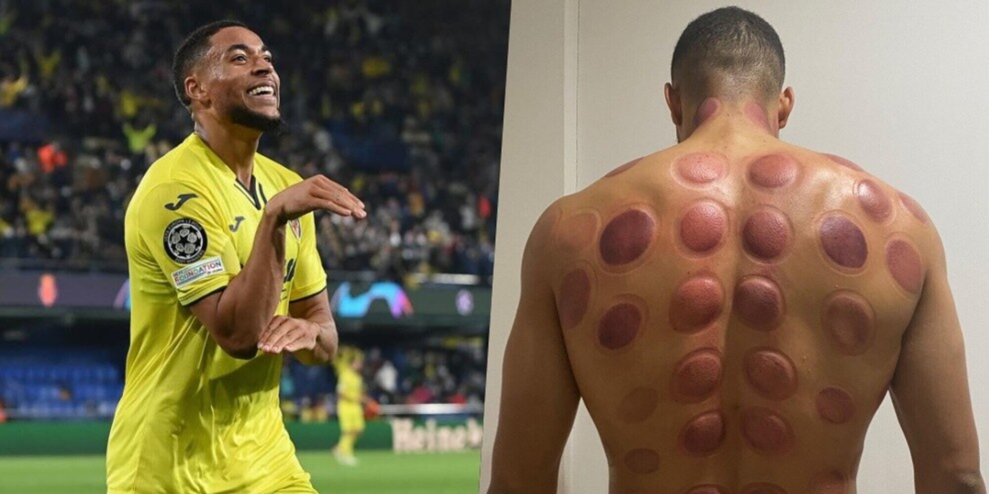 Villarreal, Danjuma pronto per l'Atalanta: ecco gli effetti della ventosaterapia
