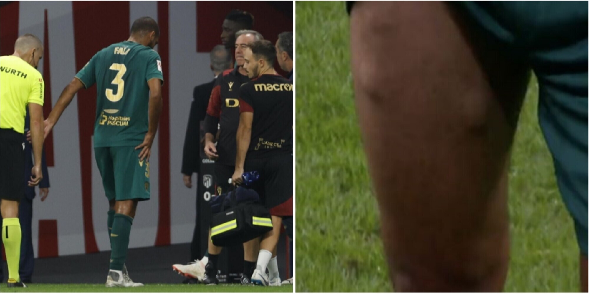 Liga shock, sulla coscia spuntano tre noduli: "Mai visto prima". Cos'è successo