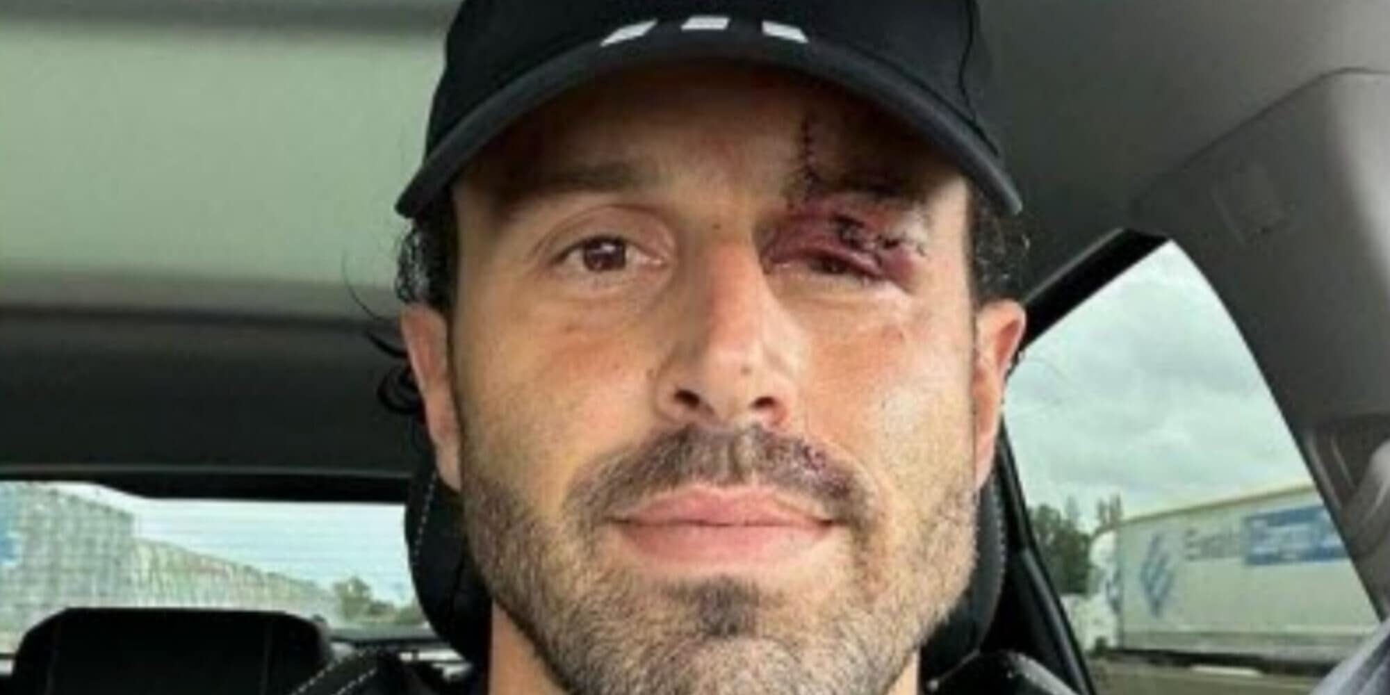 Grosso, il volto tumefatto dopo l’agguato: ha rischiato di perdere un occhio