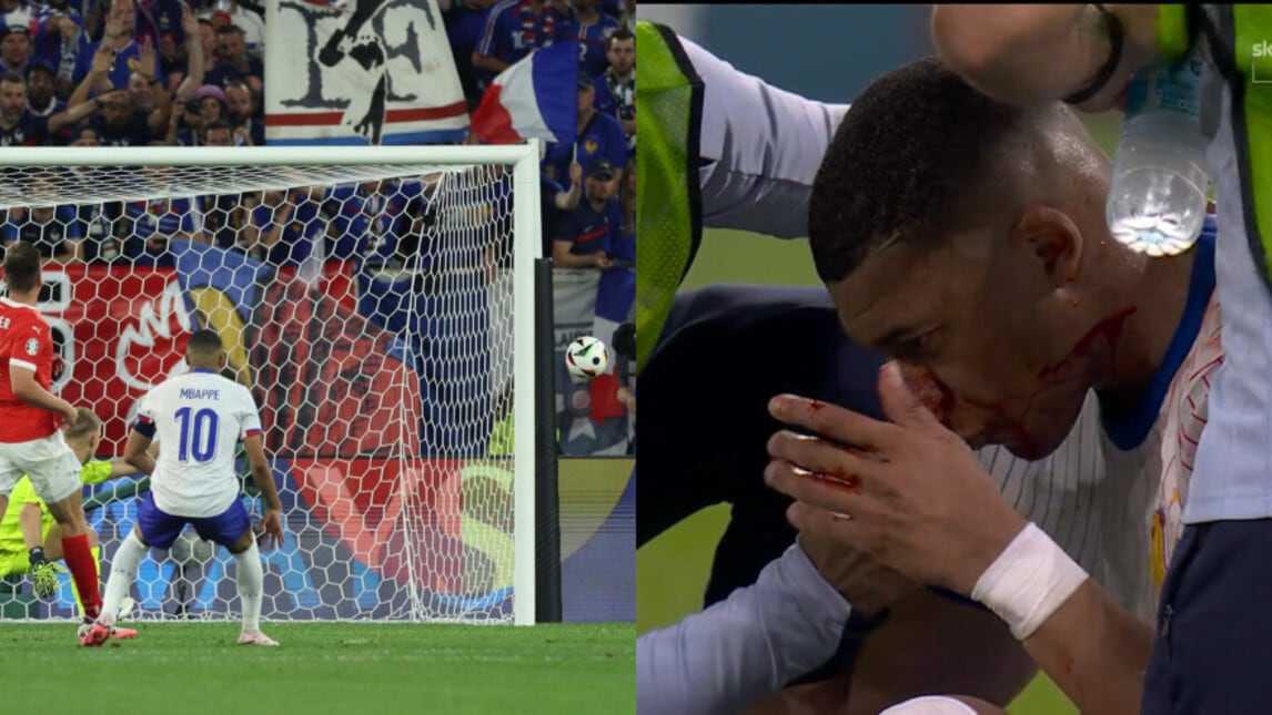 Austria-Francia, per Mbappé prima il gol sbagliato e poi il colpo violentissimo al naso