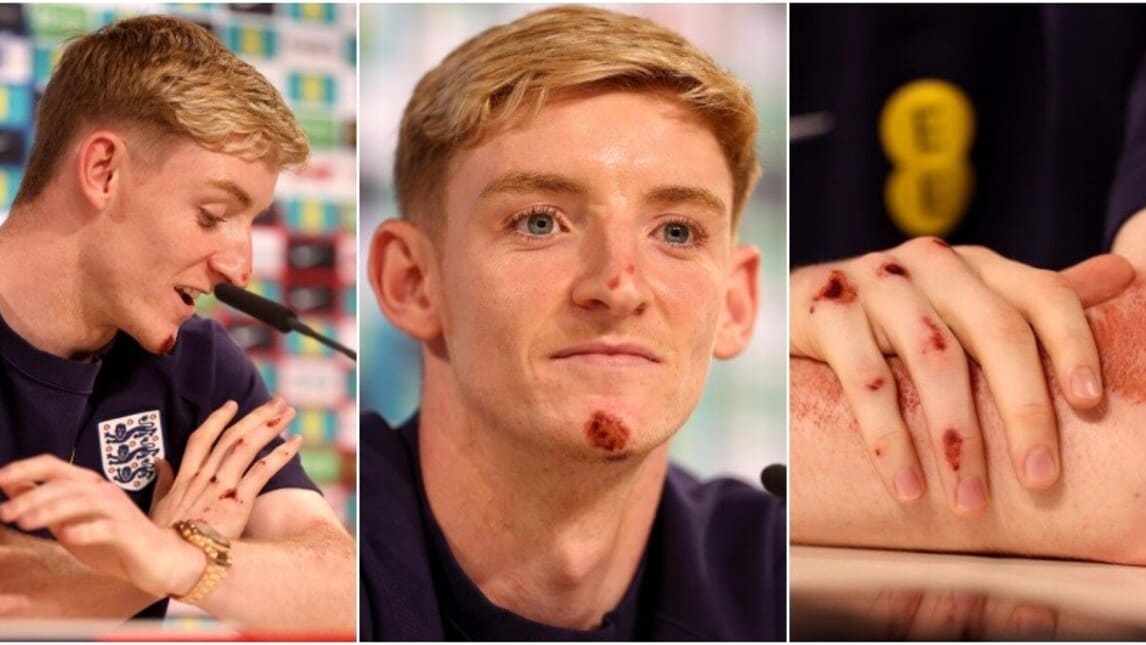 Gordon, le ferite per la caduta in bici sono virali: le foto