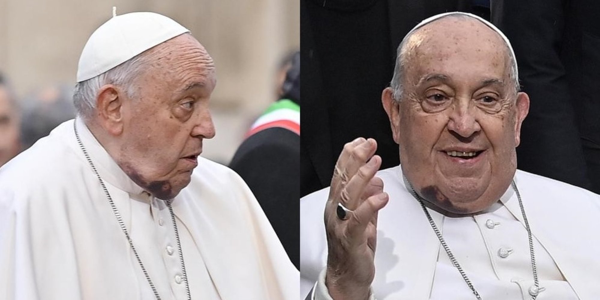 Il Papa con un grosso livido sul mento: ecco cosa gli è accaduto