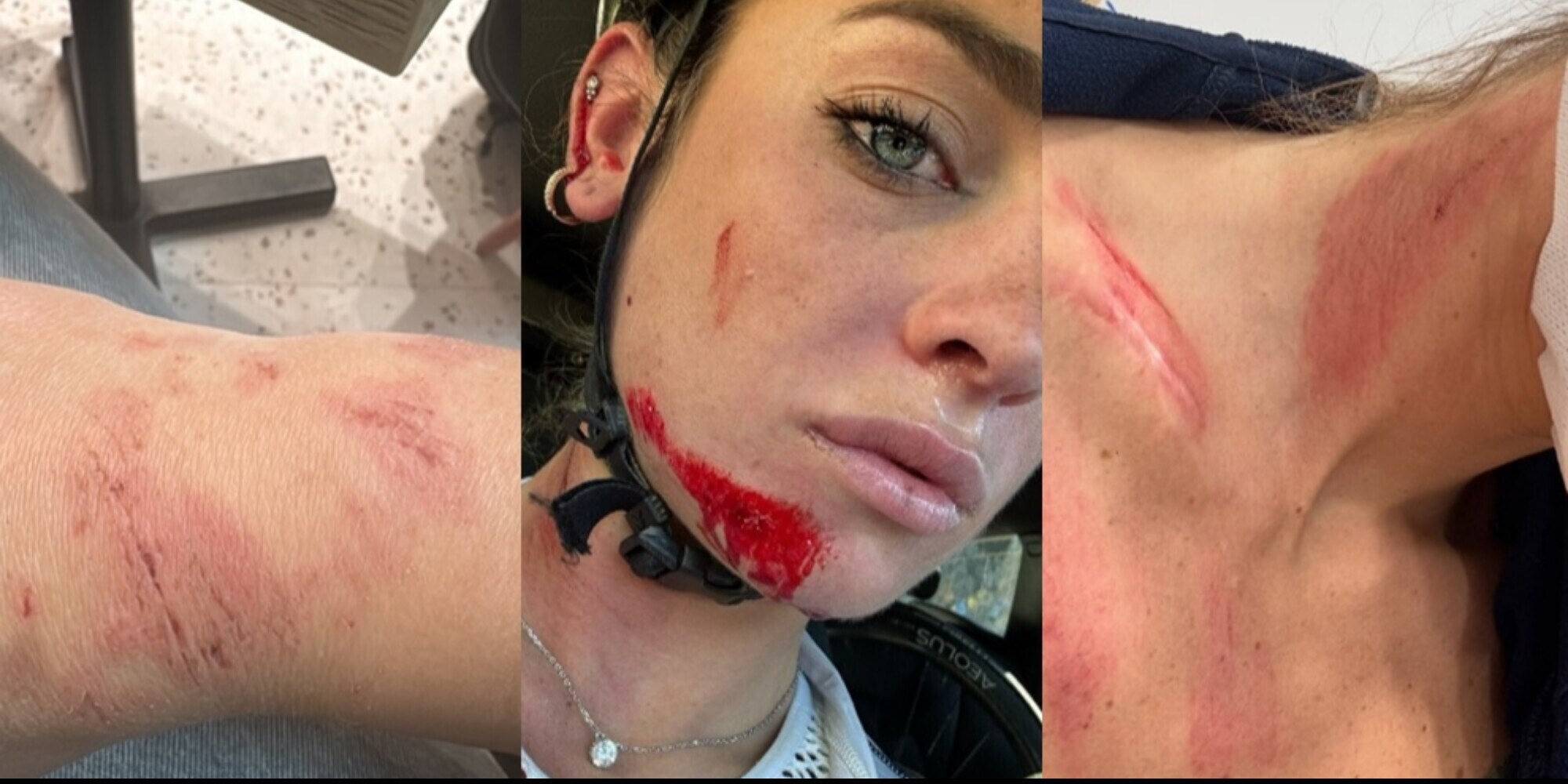 Letizia Paternoster, bruttissimo incidente: mostra le ferite impressionanti sui social