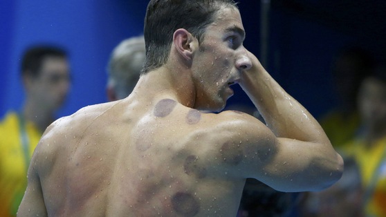 Olimpiadi, è cupping-mania tra gli atleti di Rio 2016