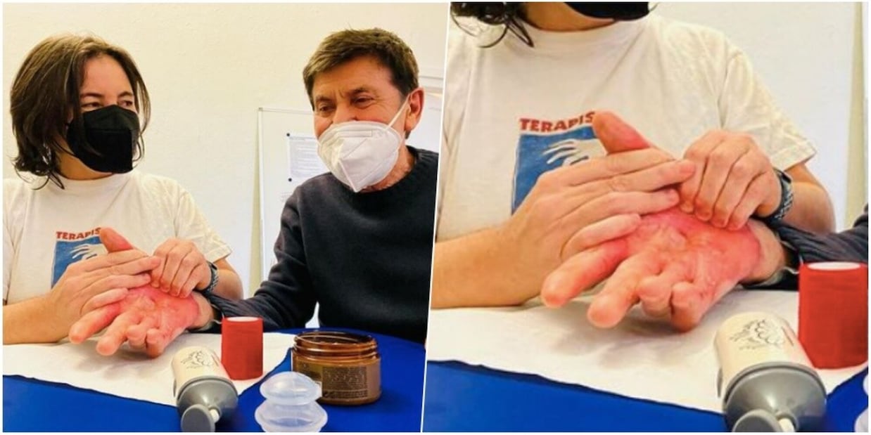 Gianni Morandi mostra la mano ustionata: fan sotto shock