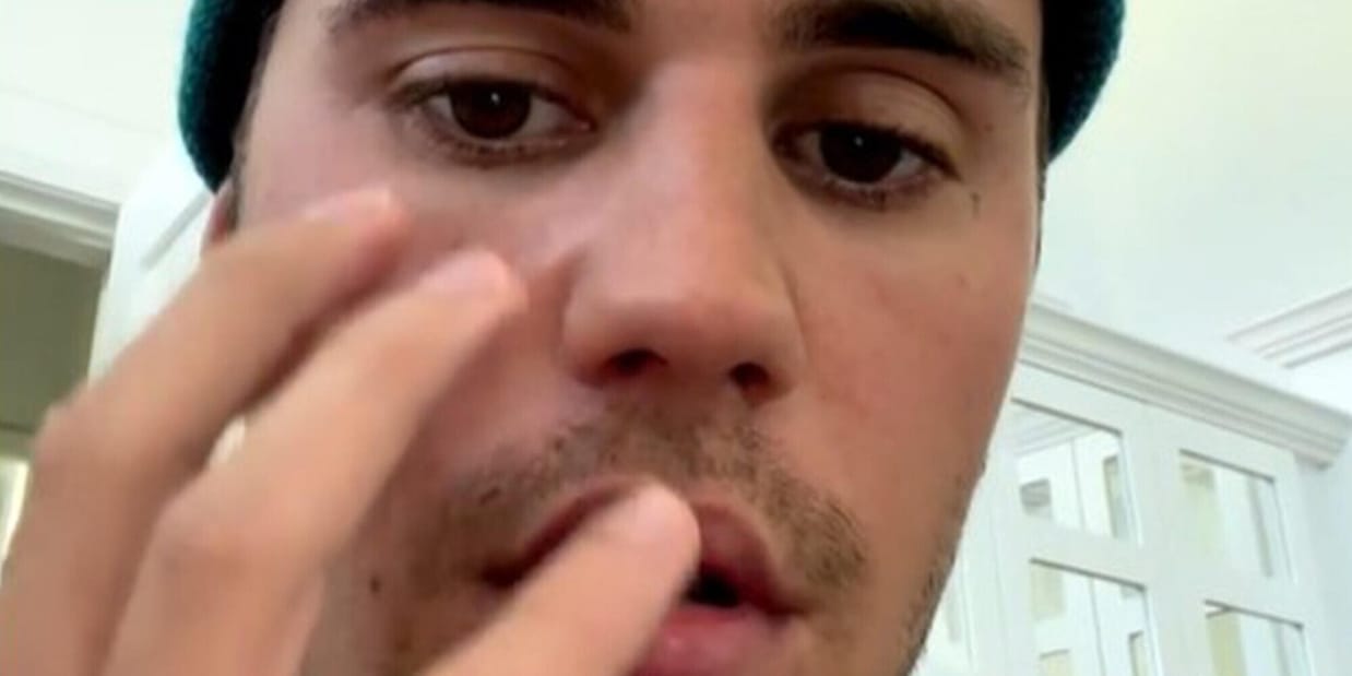 Justin Bieber ha il volto paralizzato: "Ho la sindrome di Ramsey Hunt"