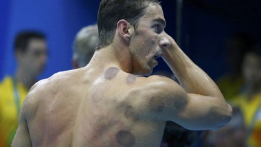 Olimpiadi, è cupping-mania tra gli atleti di Rio 2016