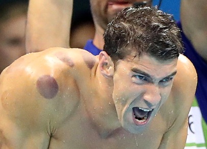 Olimpiadi, Phelps e quelle macchie da cupping
