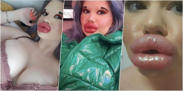 La donna con le labbra più grandi del mondo: "Voglio essere una Bratz”