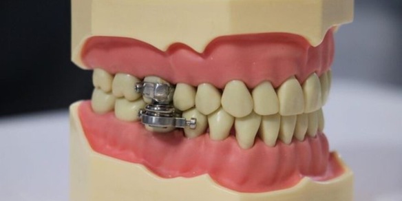 Vietato aprire la bocca: ecco la nuova inquietante tecnica dimagrante