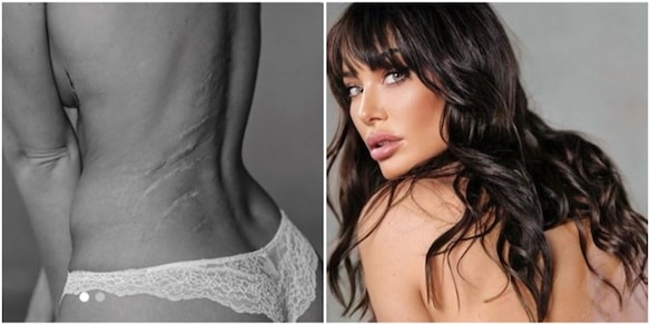 Alessia Tedeschi mostra le cicatrici con un messaggio commovente