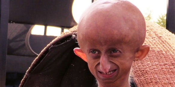 Beandri Booysen come Sammy Basso: muore a 19 anni e commuove il mondo con la sua battaglia