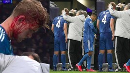 Lione-Juve, De Ligt colpito alla testa: sangue e fasciatura