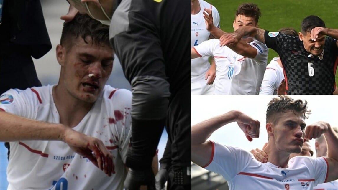 Schick, dolore e sangue: che gomitata da Lovren!