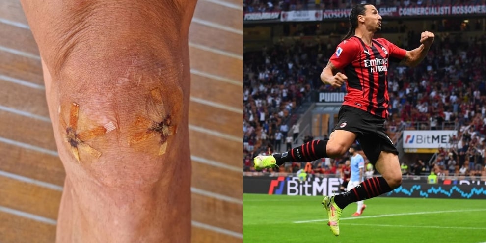 Ibrahimovic, la foto del ginocchio infortunato è impressionante