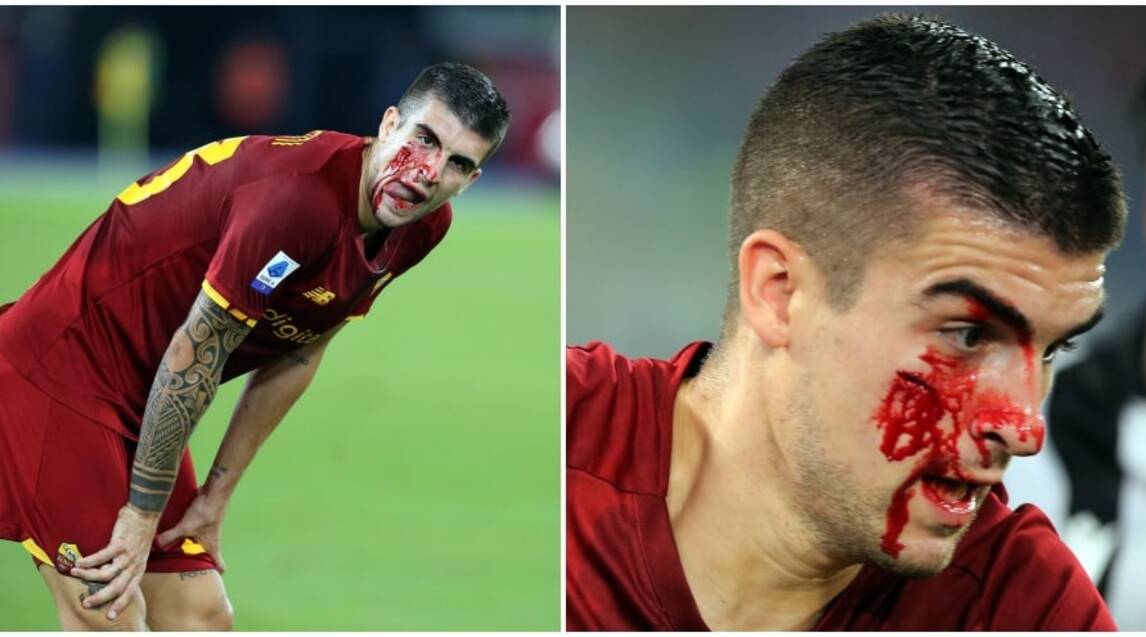 Roma-Udinese, Mancini una maschera di sangue