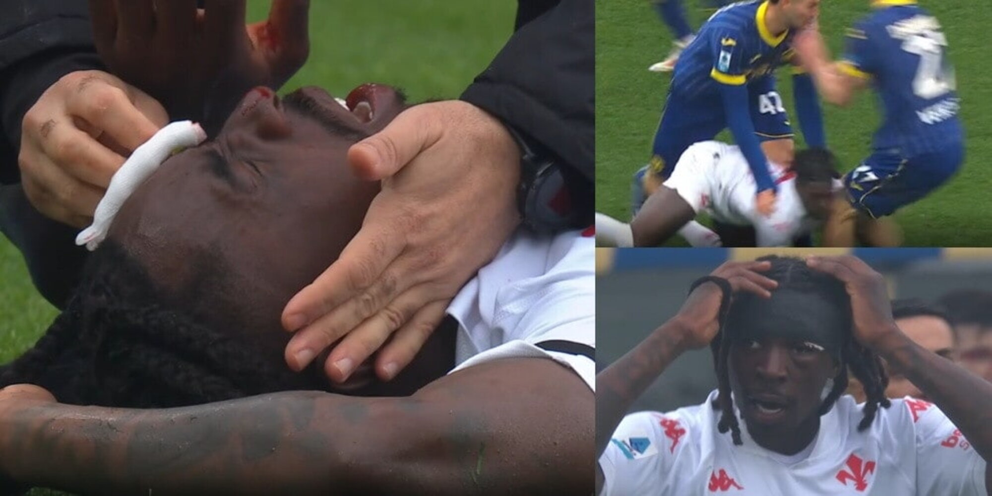 Sangue e occhio gonfio, Kean va ko: l'impatto è tremendo