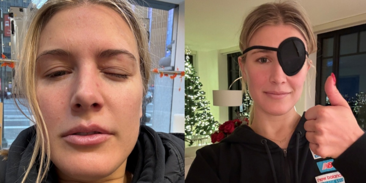 Bouchard, che combini? L'infortunio all'occhio diventa virale sui social