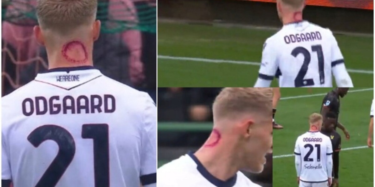 Odgaard, ma che cosa hai sul collo? No, non è il morso di uno zombie: arriva la spiegazione