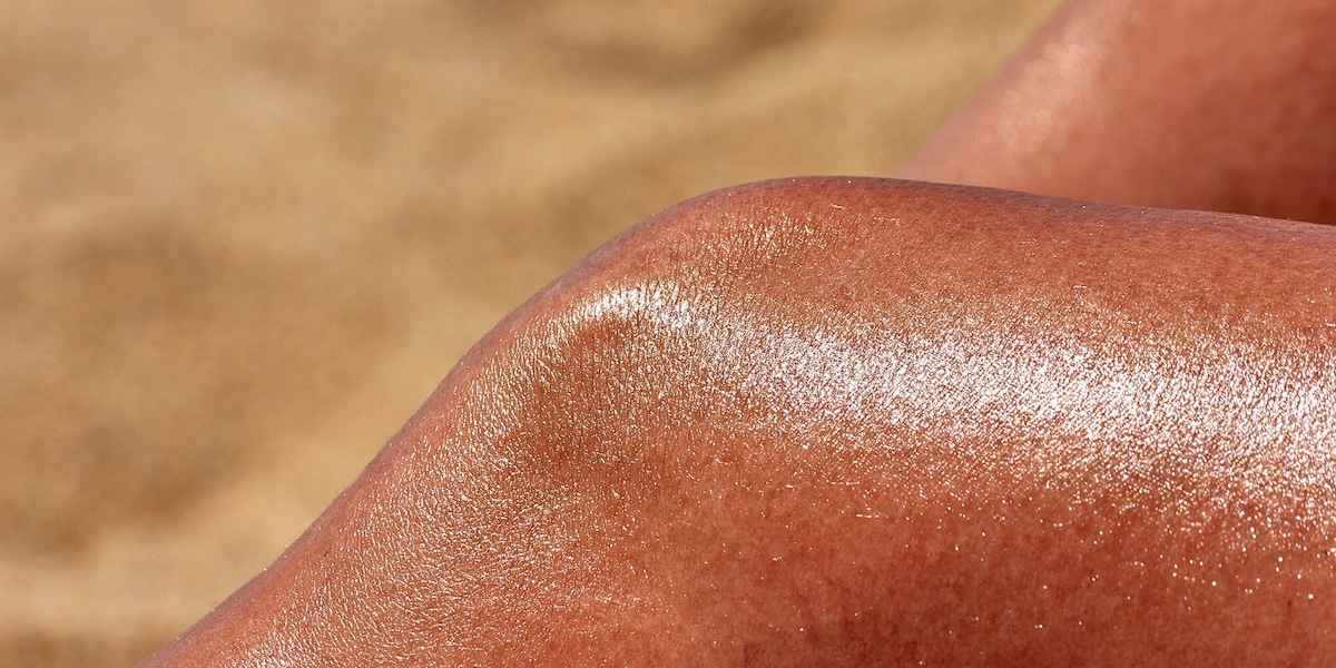 Né doposole né crema idratante: 5 rimedi naturali per scottature solari