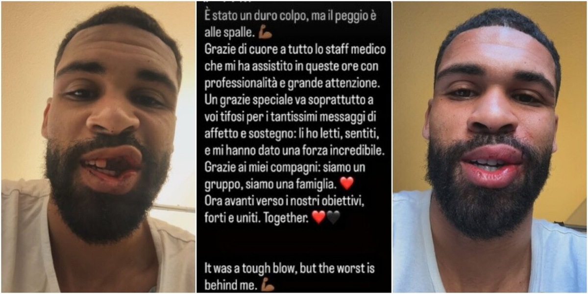 Loftus-Cheek pubblica le foto shock dell'infortunio: denti rotti e una cannuccia per alimentarsi!