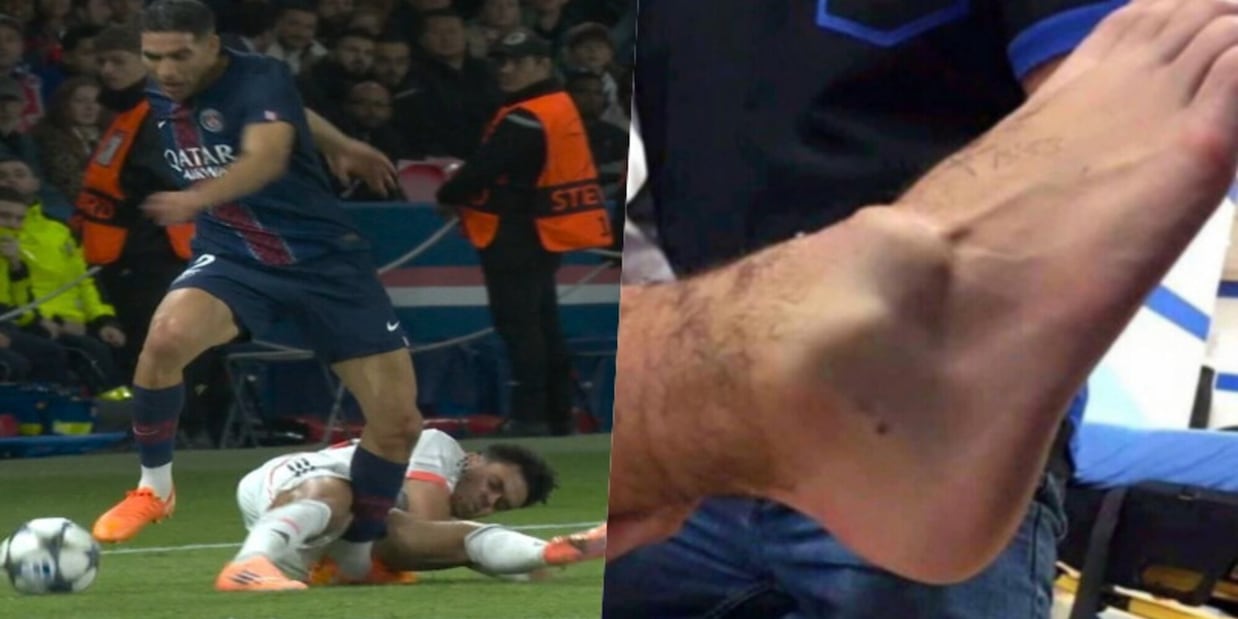 Hakimi, la scioccante foto della sua caviglia dopo il fallo killer di Luis Diaz