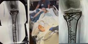 Lindsey Vonn choc: mostra la gamba piena di viti dopo sei operazioni