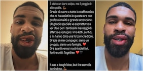 Loftus-Cheek pubblica le foto shock dell'infortunio: denti rotti e una cannuccia per alimentarsi!