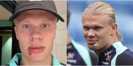 Incredibile Haaland, tre punti di sutura e visita d’urgenza dal dentista dopo un incidente sul bus: cosa è successo