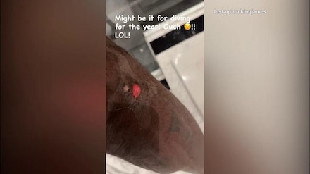 Nba, Lebron James mostra la sua ferita