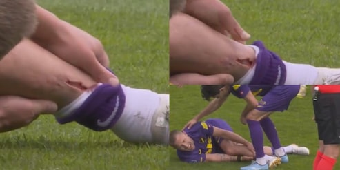 I parastinchi non reggono l'urto, l'infortunio è scioccante: le crude immagini dall'Olanda