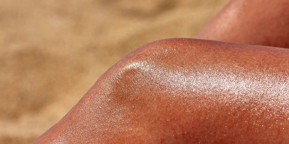 Né doposole né crema idratante: 5 rimedi naturali per scottature solari