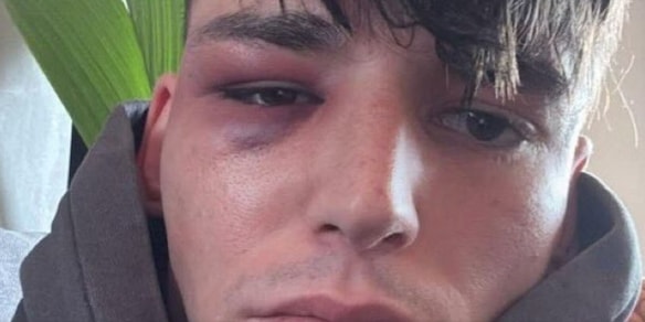 Aggressione shock all'arbitro: picchiato dopo la proposta di matrimonio al compagno